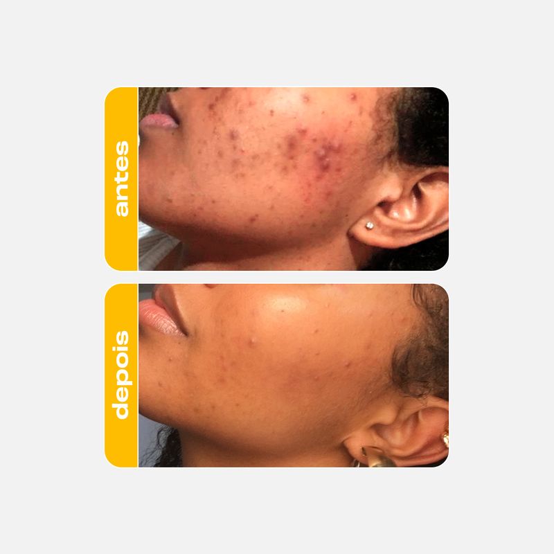 Sérum Renovador Suave - Ácido Lático