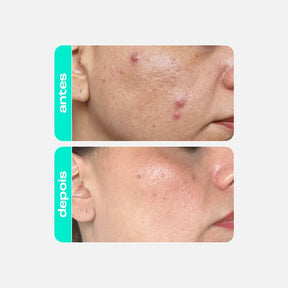 Tônico Antioleosidade - Ácido Salicílico