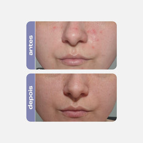 Sérum Antiacne Adapalenato