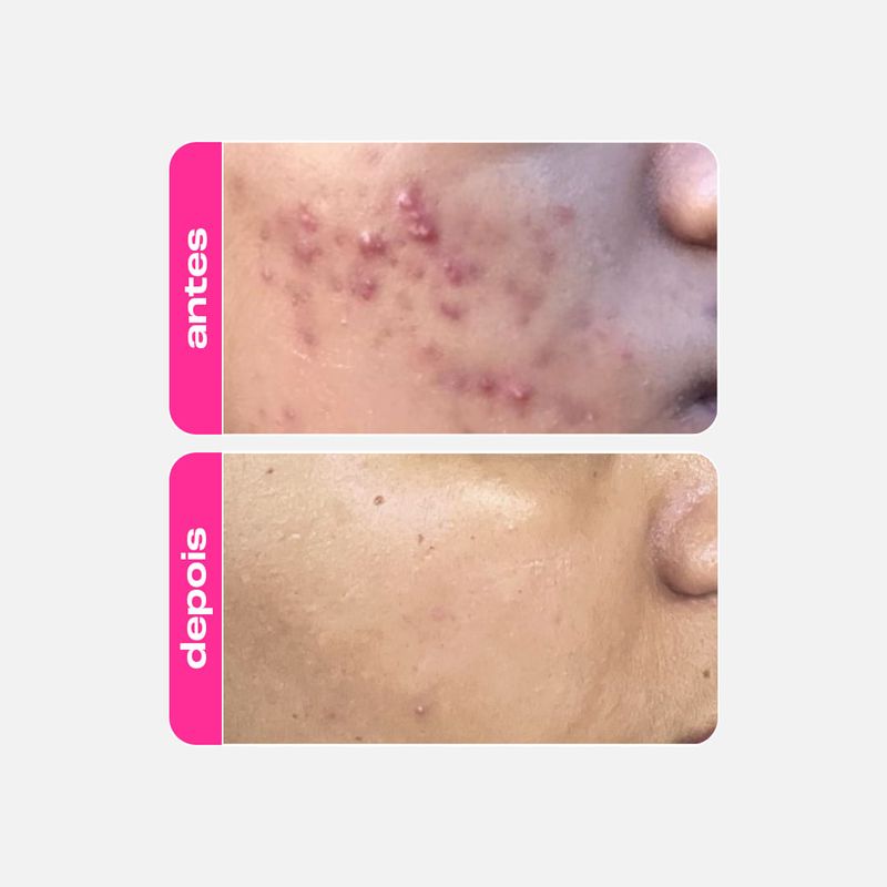 Gel Clareador Antiacne - Ácido Mandélico