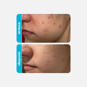 Esfoliante Químico - Ácido Glicólico