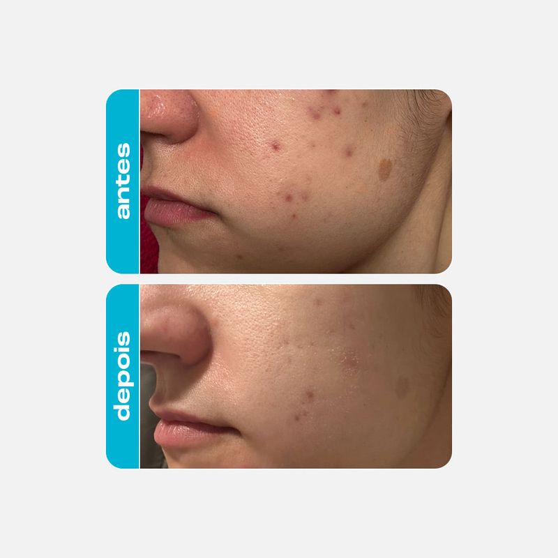 Esfoliante Químico - Ácido Glicólico