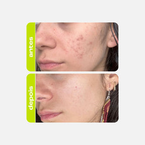 Tônico Clareador - Ácido Tranexâmico