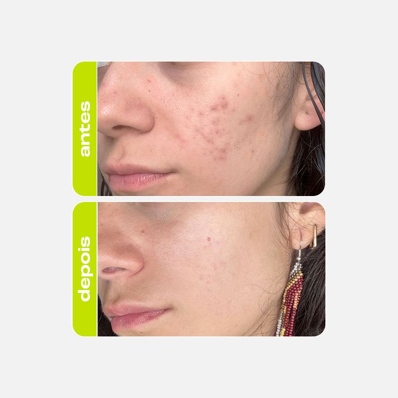 Tônico Clareador - Ácido Tranexâmico