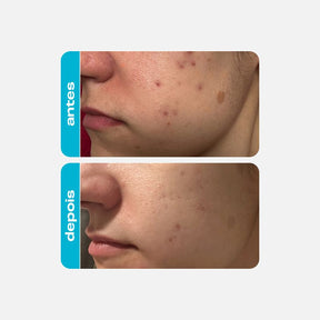 Refil Ácido Glicólico 30g